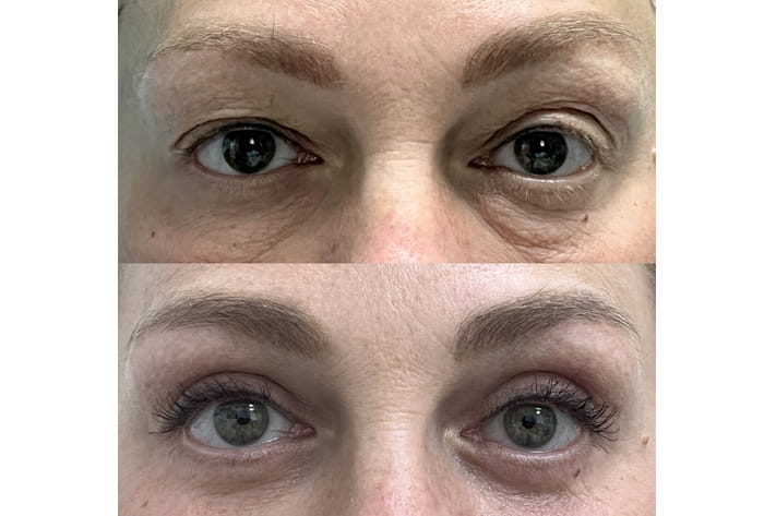 коррекция дерматохалазиса верхних и нижних век